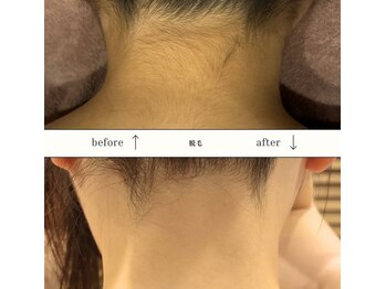 ビーエヌ エステティックアンドスパ(BN Esthetic&Spa)/うなじIPL脱毛