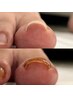【FOOT】巻き爪ケアジェル（両親指）＋フットジェルワンカラー
