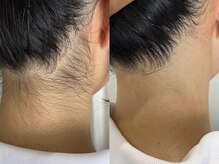 シロ(Shiro)/うなじのデザイン脱毛