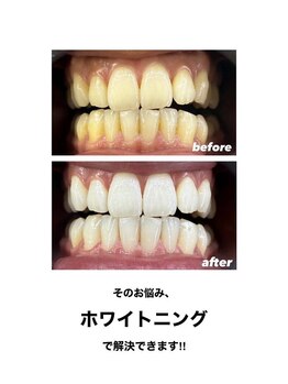 エクシアホワイトニング 京都四条店/ホワイトニングビフォーアフター