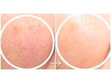 エステドブルー(Este de Bleu)/ビフォーアフター