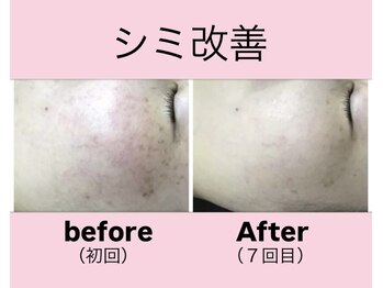 エステティック　レイビス 渋谷店(RAYVIS)/しみケア、赤みケア♪