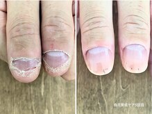 コバコ(kobaco)/弄り癖改善　ケア5回目