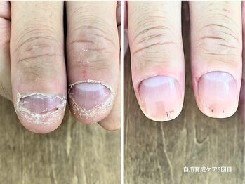 コバコ(kobaco)/弄り癖改善　ケア5回目