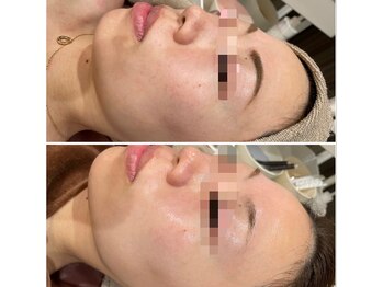 リリ(LiLi)/ビオフィート・ビフォーアフター