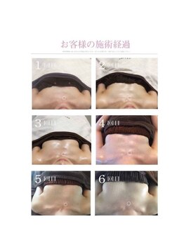 ソラ(sora)/バストアップ・バストケア症例★