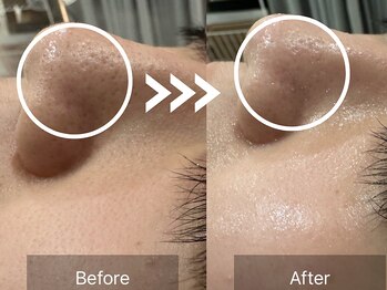 ケアナ 梅田店(CareNa)/毛穴悩みもすっきり/黒ずみケア