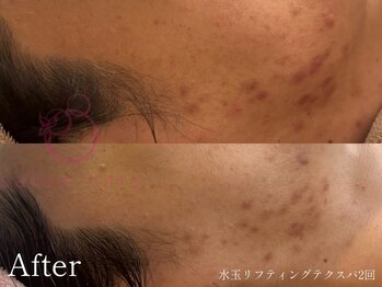 サロンヴェアリー 広尾(salon vary)/ニキビケア#跡#赤み