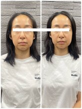 長寿鍼灸院 長寿整骨院/美容鍼25本の効果★小顔効果