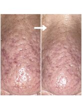 カミーシャ(KaMi-Sha)/【50代男性】毛穴改善症例写真