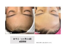 サロン ド メタセコイア(salon de Metasequoia)/【ジュニア脱毛】before／after