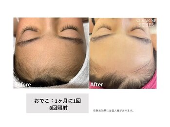 サロン ド メタセコイア(salon de Metasequoia)/【ジュニア脱毛】before／after