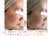 【かんぱん】他店で効果がなかった方必見！瞼のモヤモヤシミまで改善￥12000