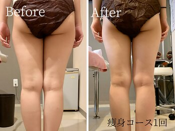 ビューティスト(Beautist)の写真/頑固なヒップまわり、太ももの《脂肪をマシン×熟練ハンド》で徹底ケア!憧れの美ボディをGETしませんか♪