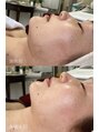 AK エステティックス(AK Esthetics)&nbsp;ラジオ波でリフトアップ！美しい輪郭【#ラジオ波フェイシャル】