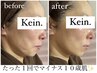 【爆誕！若見え肌！】リフトアップでたるみ改善☆¥11,000→¥7,700
