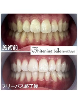 ホワイトニングサロン 京都烏丸店/ホワイトニング施術例　