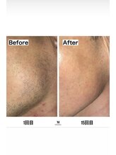 ミセレルオカザキ(MISEREL OKAZAKI)/髭脱毛