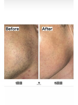 ミセレルオカザキ(MISEREL OKAZAKI)/髭脱毛