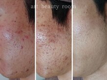 アート ビューティールーム(art beauty room)/☆ハーブピーリング＆オーダー