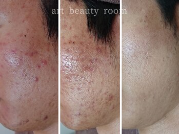 アート ビューティールーム(art beauty room)/☆ハーブピーリング＆オーダー