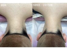 エステティック レイビス 池袋店(RAYVIS)/うなじ脱毛６回での効果