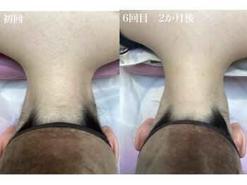 エステティック レイビス 池袋店(RAYVIS)/うなじ脱毛6回での効果