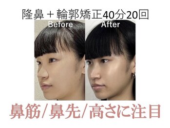 ラプリ 梅田店(Raplit)/隆鼻＋輪郭矯正40分20回