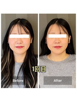 ソルビーフェイス(SOL*BeFace)/1回目頬がリフトアップ♪