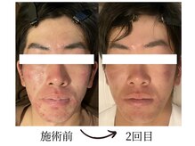 コガオファクトリー 北24条店(KOGAO FACTORY)/メンズニキビケアコース