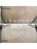 【次世代ピーリング×初体験（刺激レス・剥離なし）はじめて安心プラン11,000