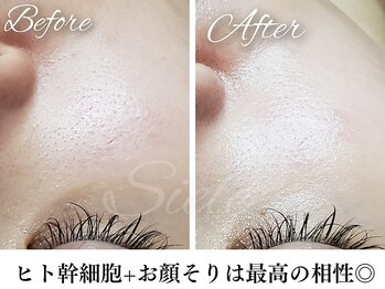 シエル(Siele)/シェービング+ヒト幹細胞で美肌