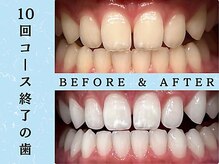 ホワイトニングショップ 浦和店/10回コース/ビフォーアフター