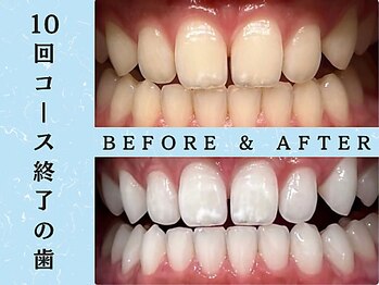 ホワイトニングショップ 浦和店/10回コース/ビフォーアフター