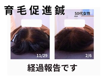 アンスリウム美容整体院 鍼灸院 接骨院/育毛を促す鍼