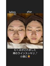 スタジオ オグラ(Studio-Ogura)/ピーリング　イメージ４