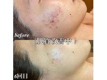 ビジュープラス 広島店(Bijou+)の雰囲気（有名インフルエンサーもREVIハーブピーリングで美肌ケア♪）