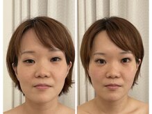 アンドモア(&more)/小顔症例