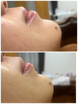 ラピス(Lapis)/シェービングエステ