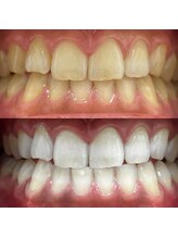 ハリス(HARIS)/セルフホワイトニング