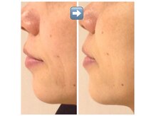 レーヴリゼ(Revelise)/ララピール＋ララピールパック