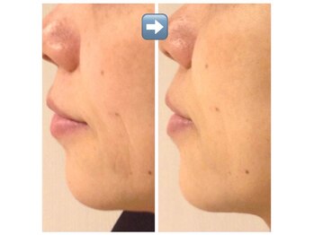 レーヴリゼ(Revelise)/ララピール+ララピールパック