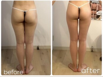 プリマ(prima)/下半身痩せ症例