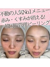 あすはれ/ザラつき赤み乾燥毛穴悩みを一掃