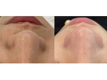 ルミナエステ(LUMINA ESTH)/毛穴／毛穴洗浄／毛穴ケア｜症例