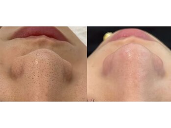 ルミナエステ(LUMINA ESTH)/毛穴/毛穴洗浄/毛穴ケア|症例