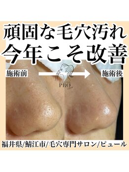 ピュール 鯖江店(PUR)/毛穴/毛穴ケア/毛穴洗浄