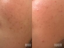 ウォーム(warm)/シミケア/美白/脱ピーリング