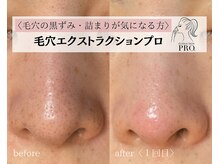 スイ(Suui.)の雰囲気（毛穴の黒ずみ・角栓詰まり解消！）