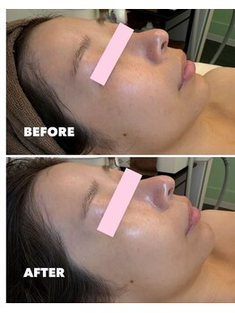 ギルドハナレ(GUILD HANARE)/"顔脱毛×ピーリング"